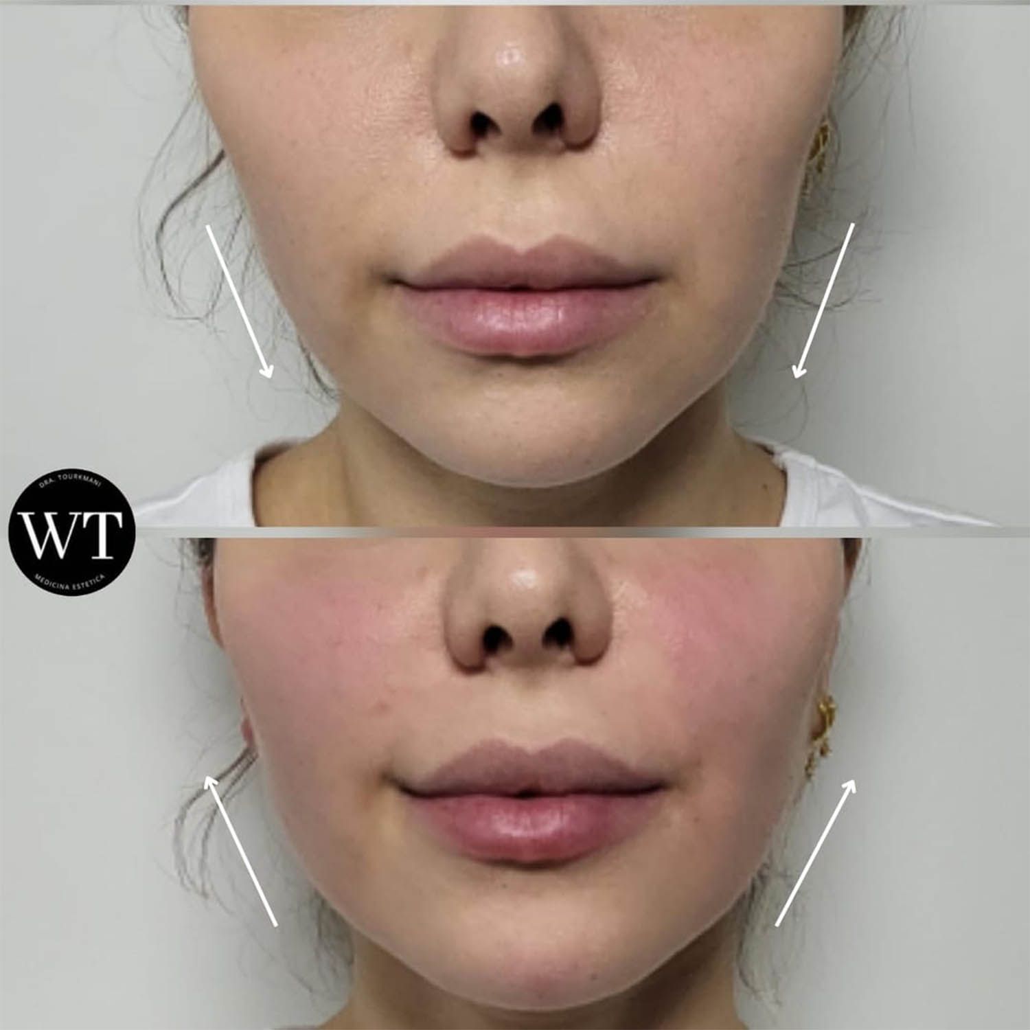 antes y despues medicina estetica facial_Widad Tourkmani_clinica diet_01