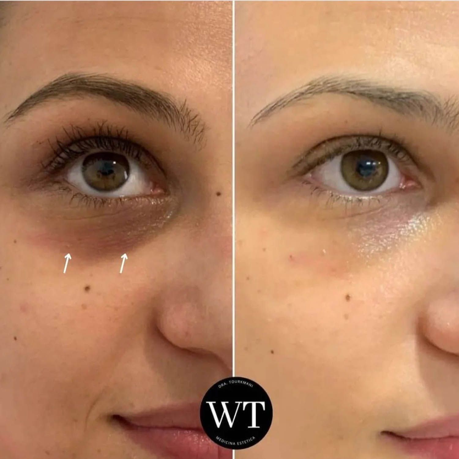 antes y despues medicina estetica facial_Widad Tourkmani_clinica diet_02