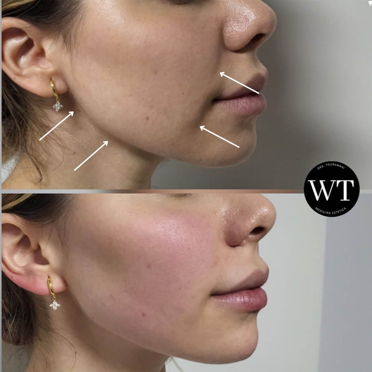 antes y despues medicina estetica facial_Widad Tourkmani_clinica diet_03