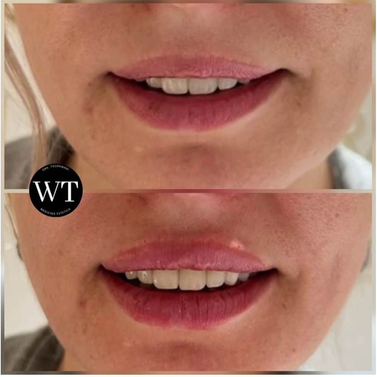 antes y despues medicina estetica facial_Widad Tourkmani_clinica diet_04