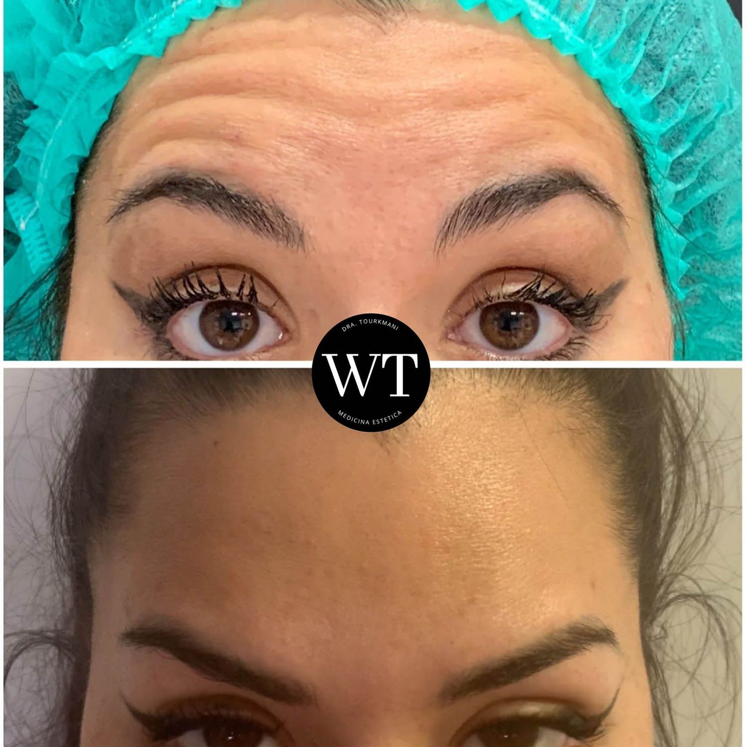 antes y despues medicina estetica facial_Widad Tourkmani_clinica diet_05