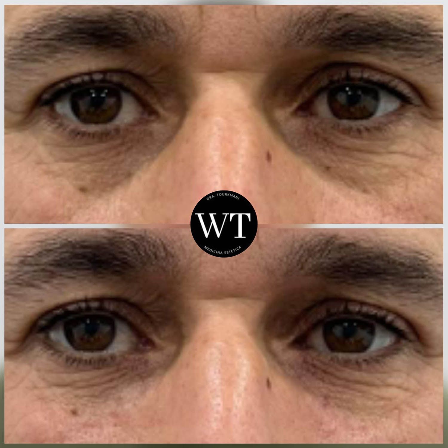 antes y despues medicina estetica facial_Widad Tourkmani_clinica diet_06