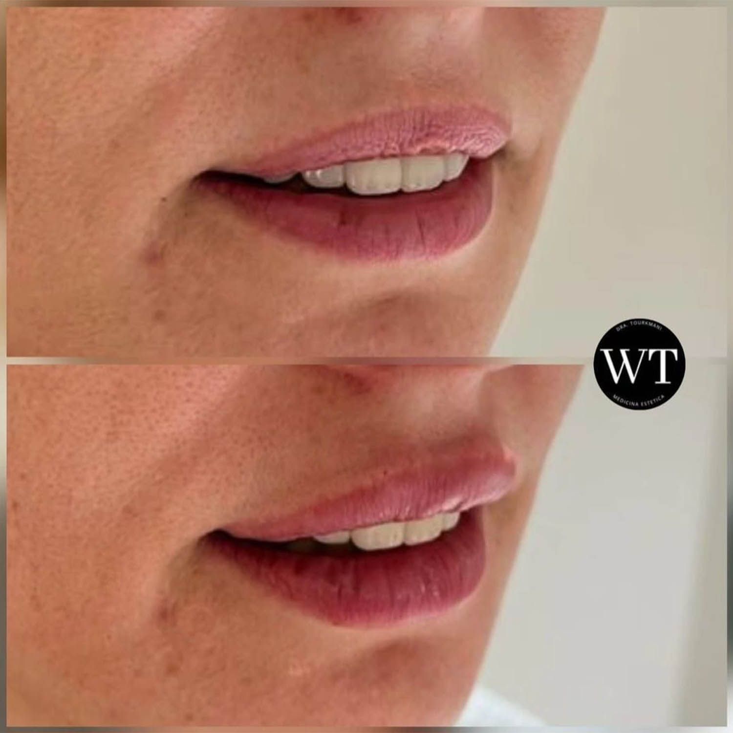 antes y despues medicina estetica facial_Widad Tourkmani_clinica diet_07