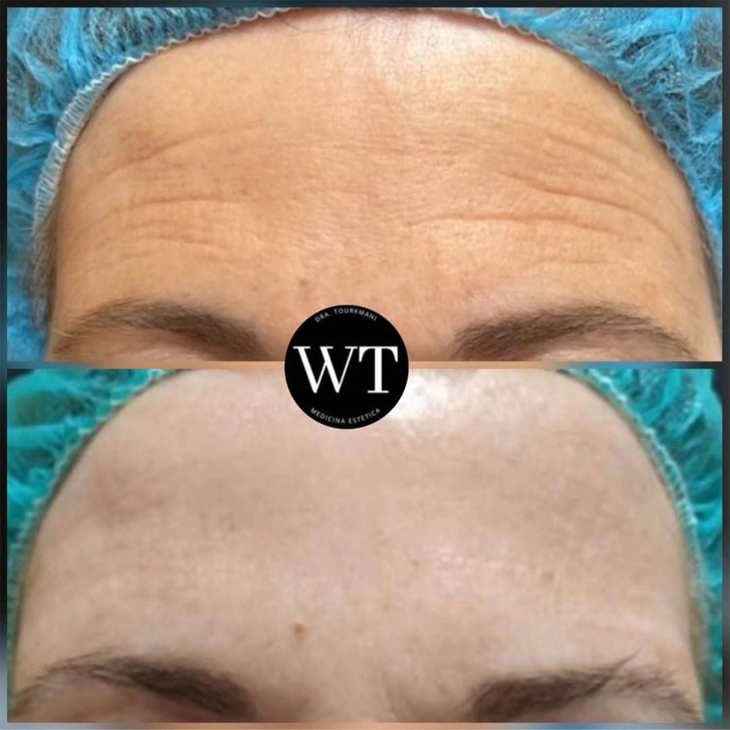 antes y despues medicina estetica facial_Widad Tourkmani_clinica diet_08