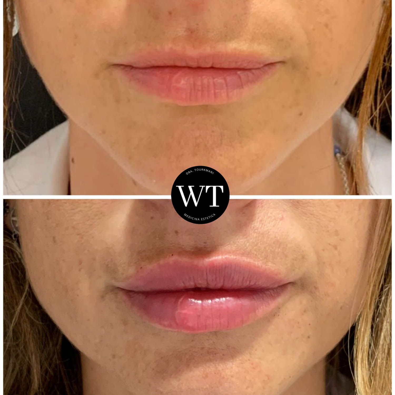 antes y despues medicina estetica facial_Widad Tourkmani_clinica diet_09