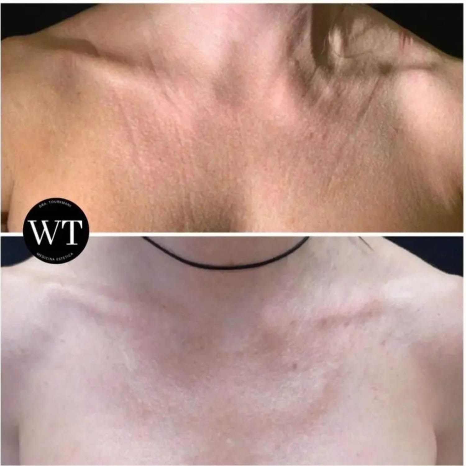 antes y despues medicina estetica facial_Widad Tourkmani_clinica diet_10