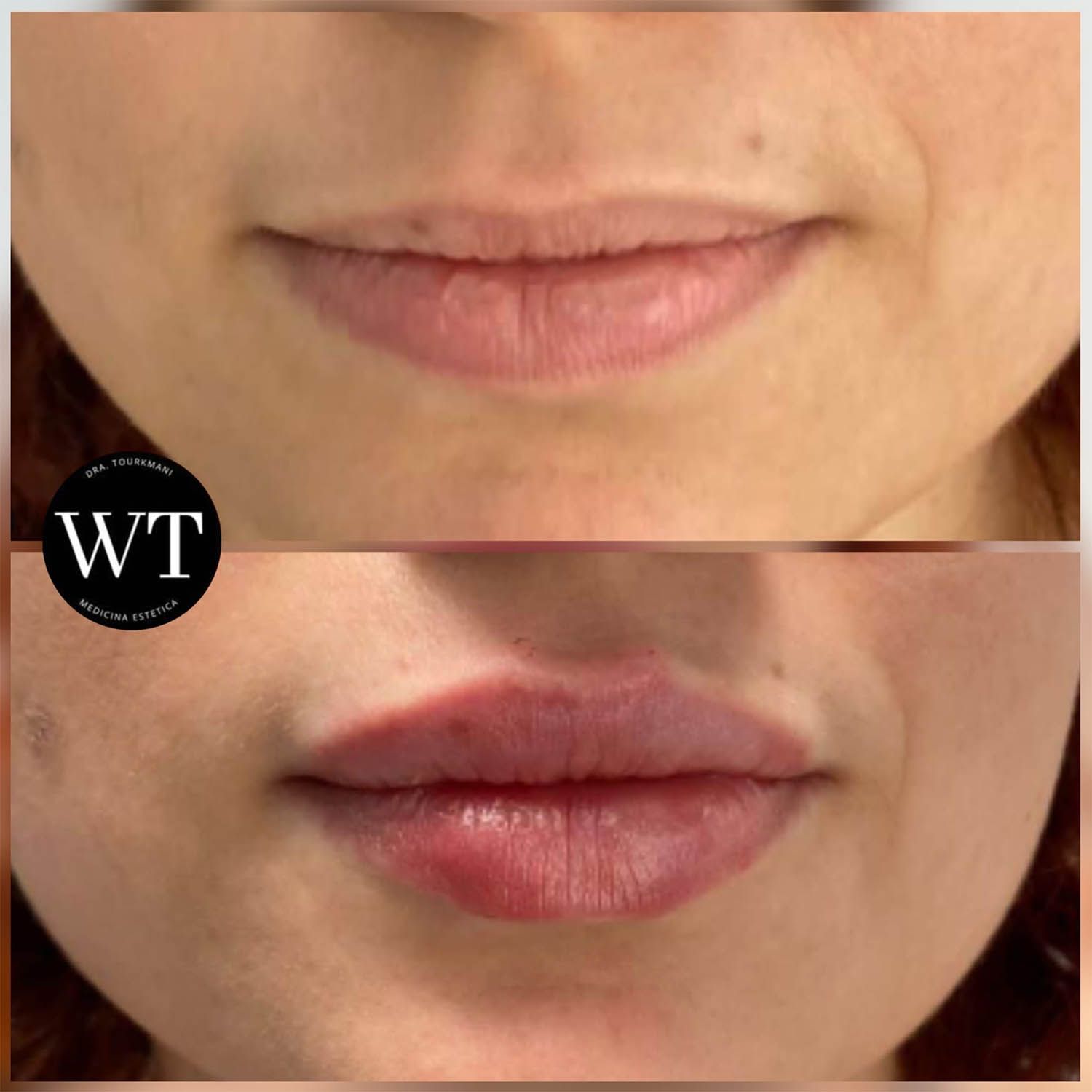 antes y despues medicina estetica facial_Widad Tourkmani_clinica diet_11
