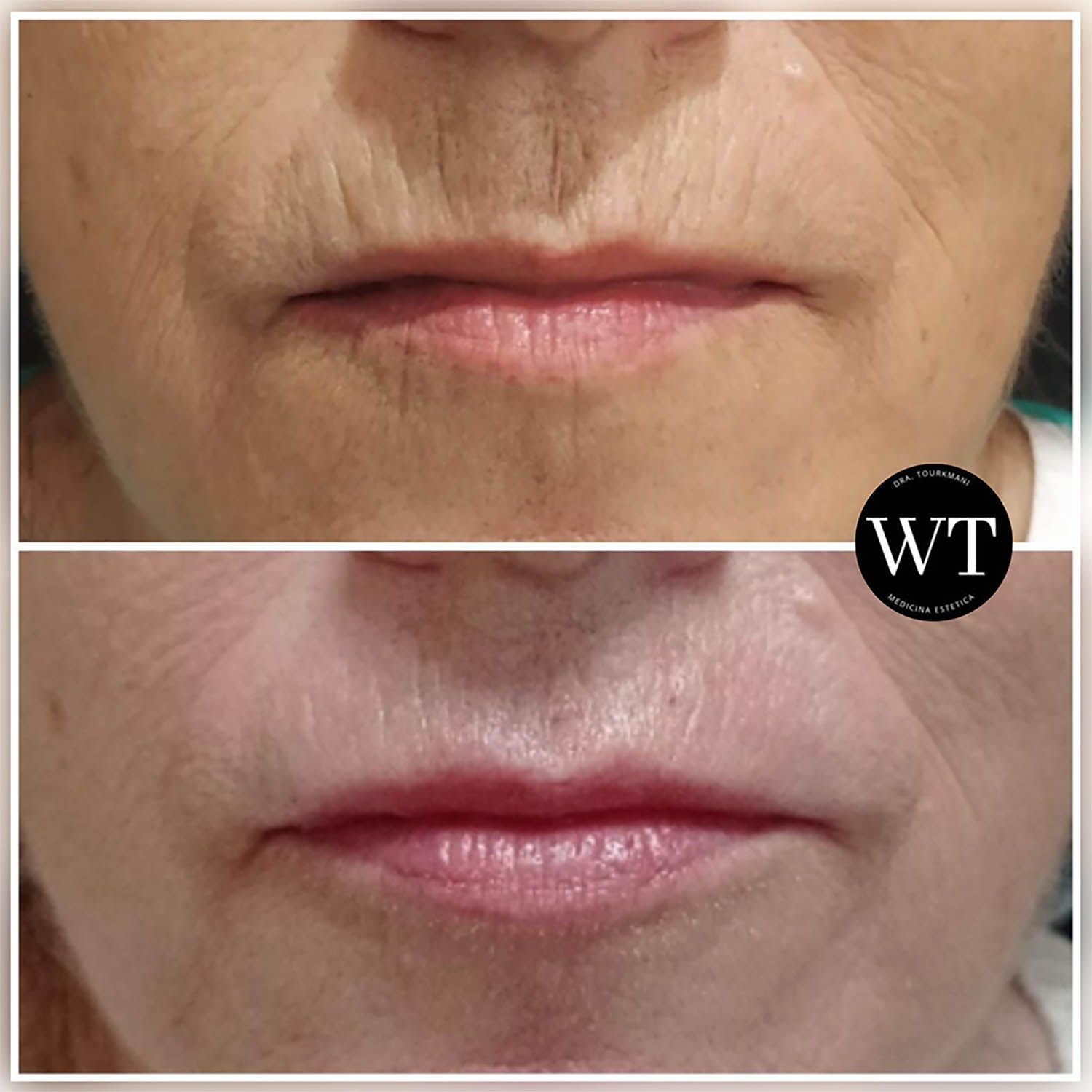 antes y despues medicina estetica facial_Widad Tourkmani_clinica diet_12